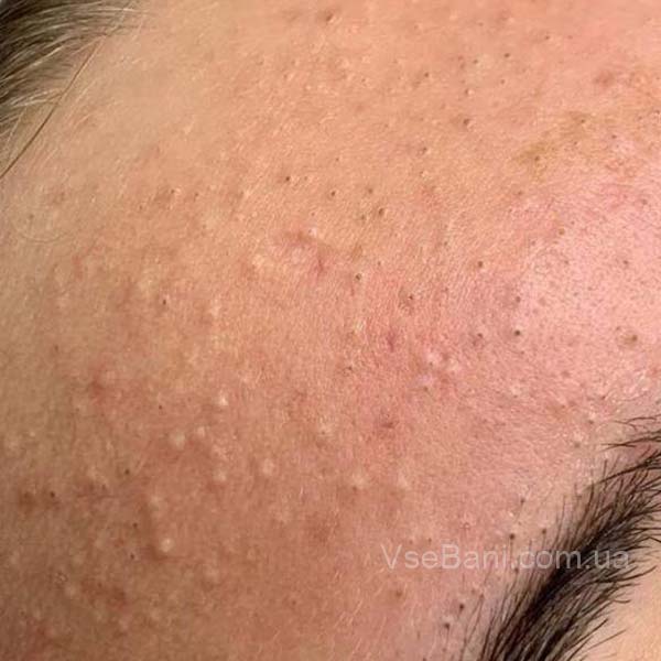 Как избавиться от прыщей Как избавиться от прыщей