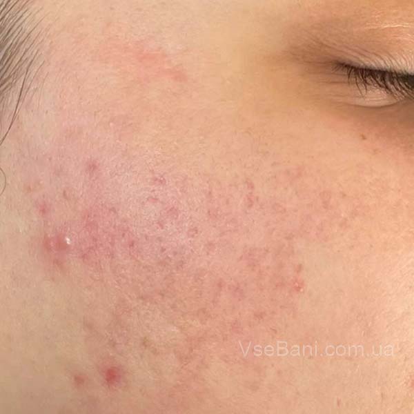 Как избавиться от прыщей Как избавиться от прыщей