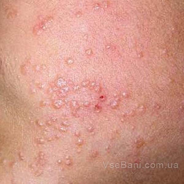 Белая сыпь на лице