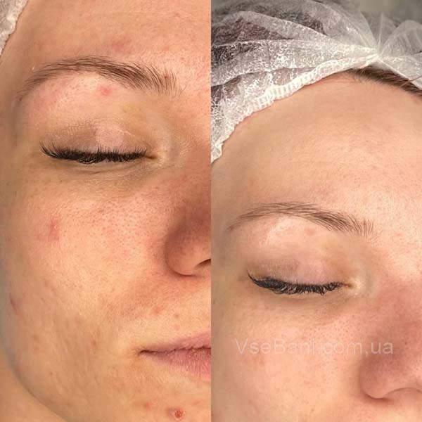 Большие черные точки вакуумная чистка