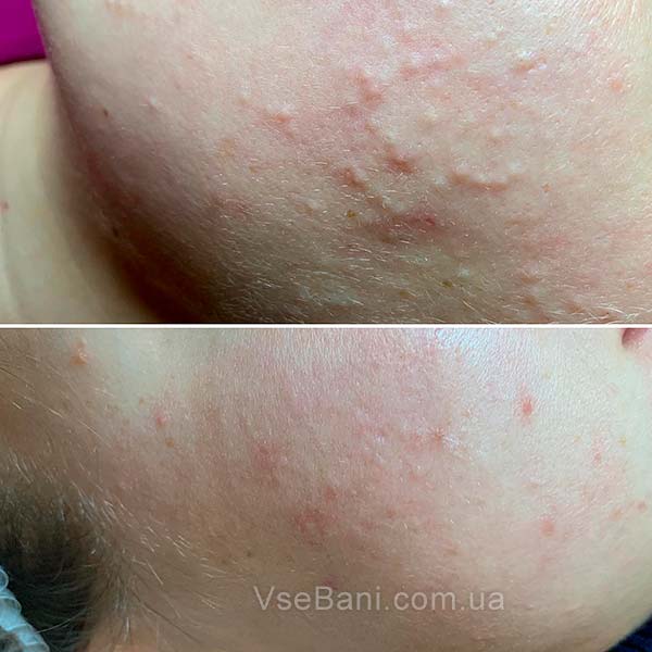 Воспаленные черные точки Воспаленные черные точки