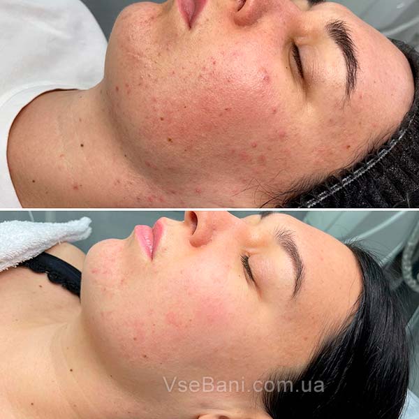 Следы от черных точек