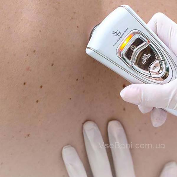 черные точки на родинке 