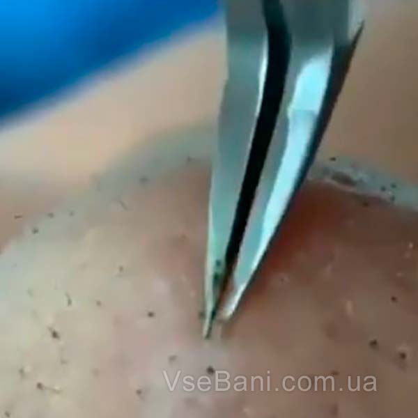 Чёрные точки на носу под микроскопом