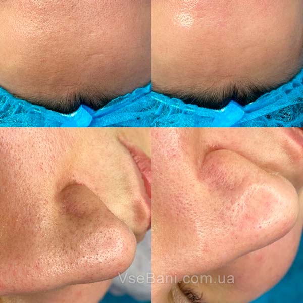 Чёрные точки на носу