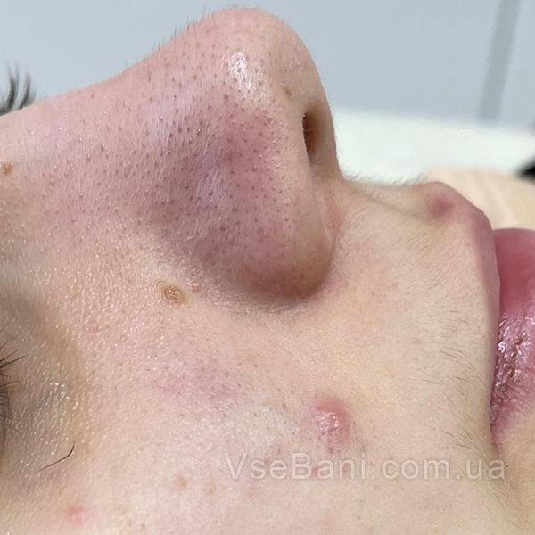 Как избавиться от акне