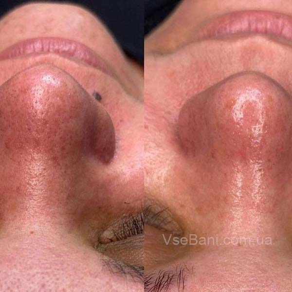 Как избавиться от черных точек навсегда