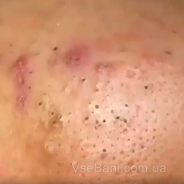 Черные точки под грудью как избавиться с помощью очищения