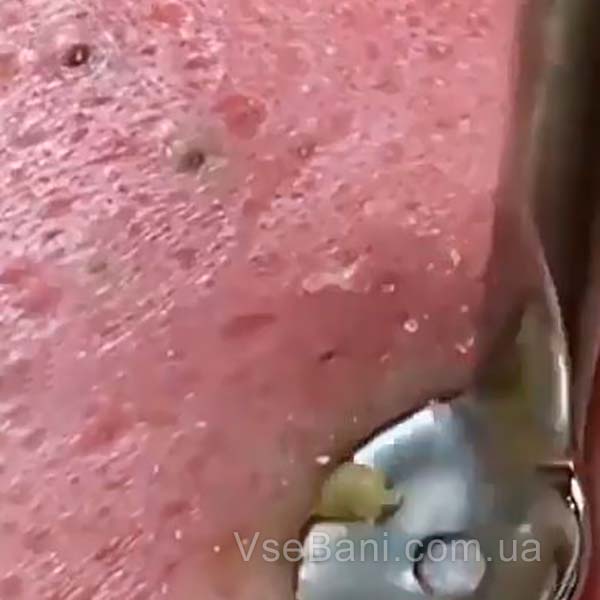 Как избавиться от черных точек на груди механической чисткой