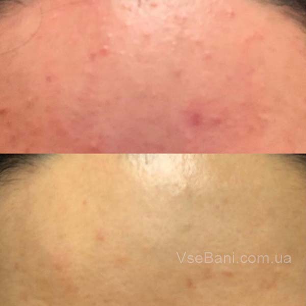 Как избавиться от гнойного прыща Как избавиться от гнойного прыща