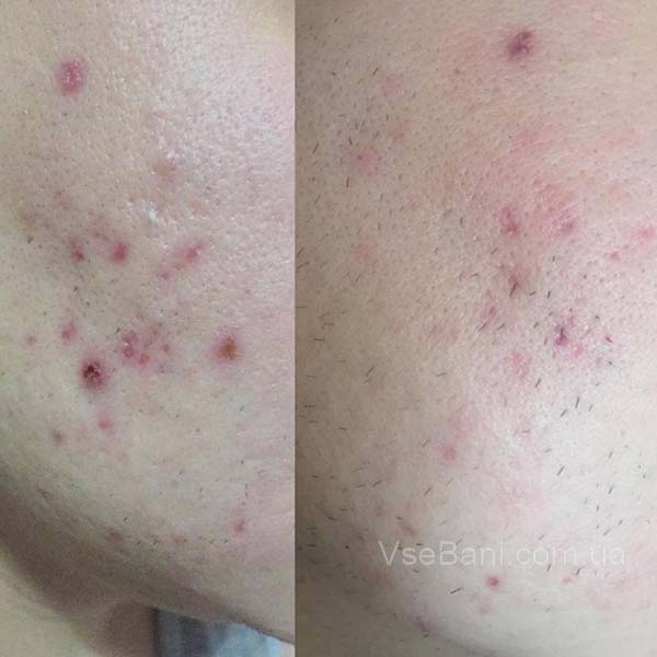 Как избавиться от гнойного прыща Как избавиться от гнойного прыща