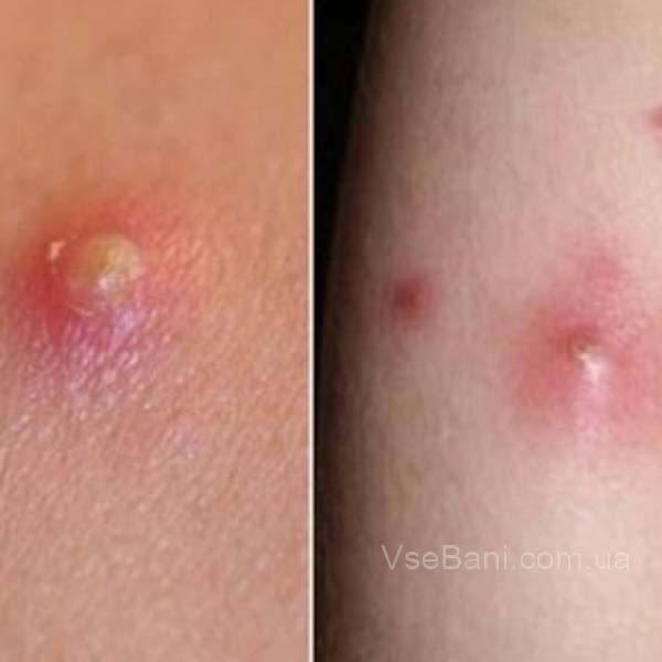 Как избавиться от гнойного прыща Как избавиться от гнойного прыща