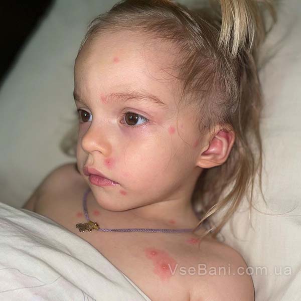 Ветрянка также проявляется сыпью