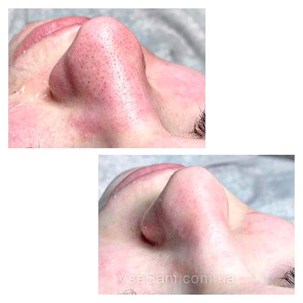 Как избавится от открытых комедонов 