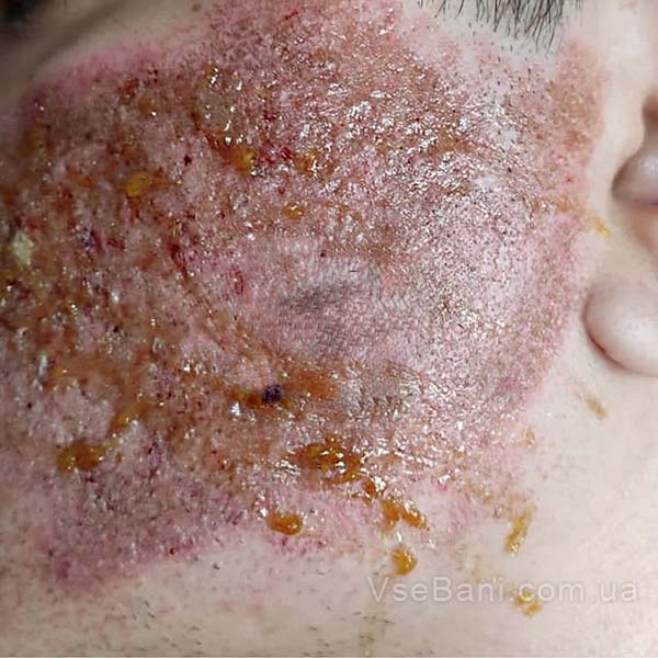 Как избавиться от постакне