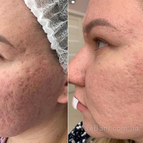 Как избавиться от постакне