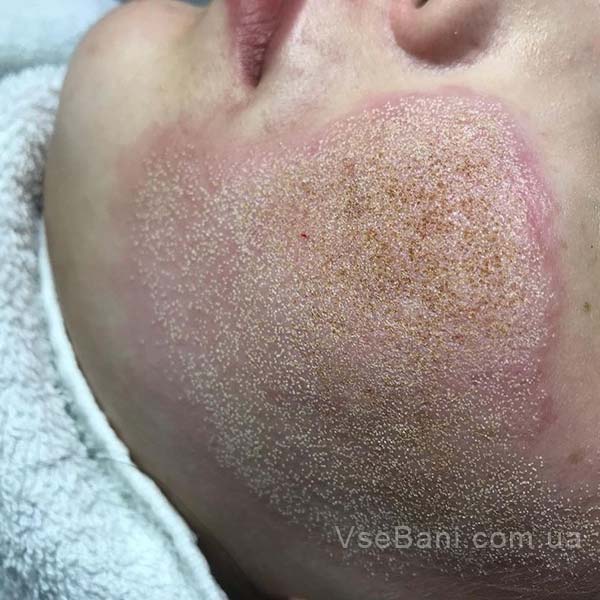 Как избавиться от постакне