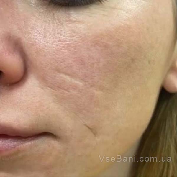 Как избавиться от постакне