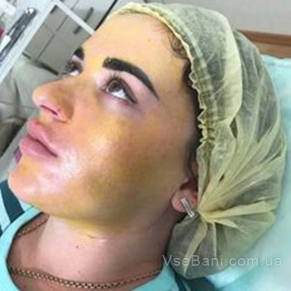 Как избавиться от постакне