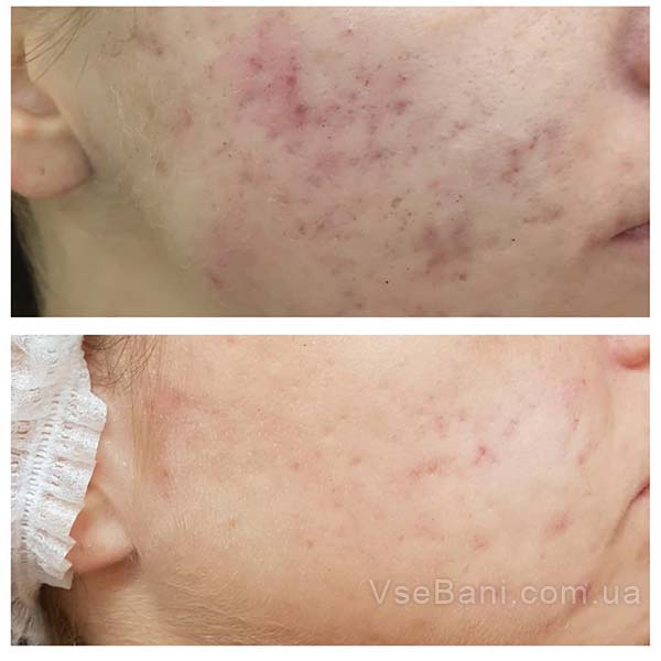 Как избавиться от постакне