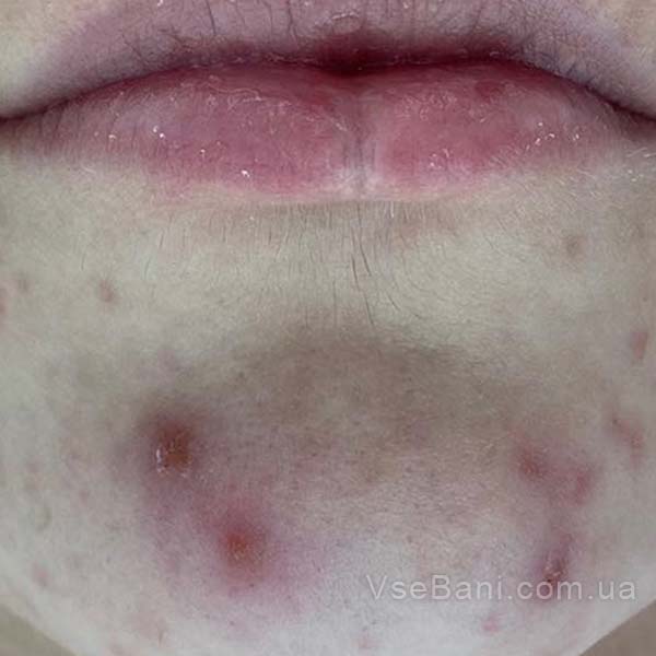 Как избавиться от постакне