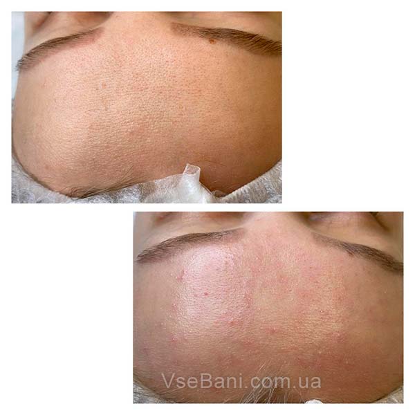 Как избавиться от прыщей и черных точек. Гормональный фон как причина