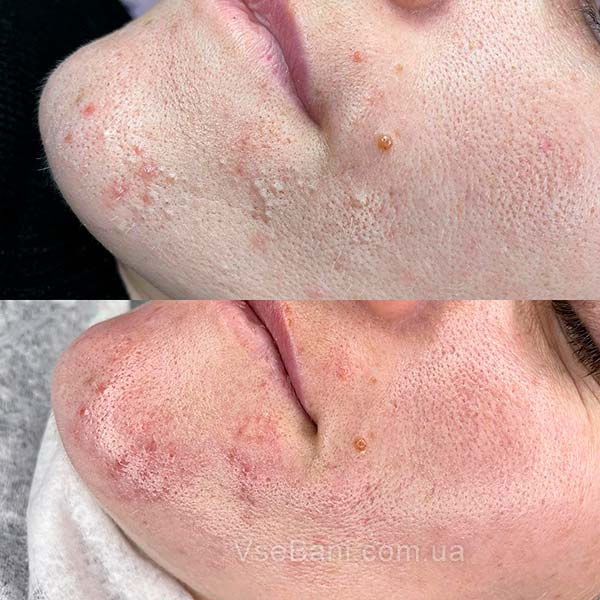 Как избавиться от прыщей и черных точек