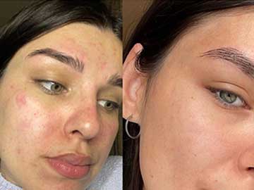 Как избавиться от прыщей Как избавиться от прыщей