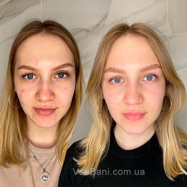 Как убрать следы от прыщей на лице