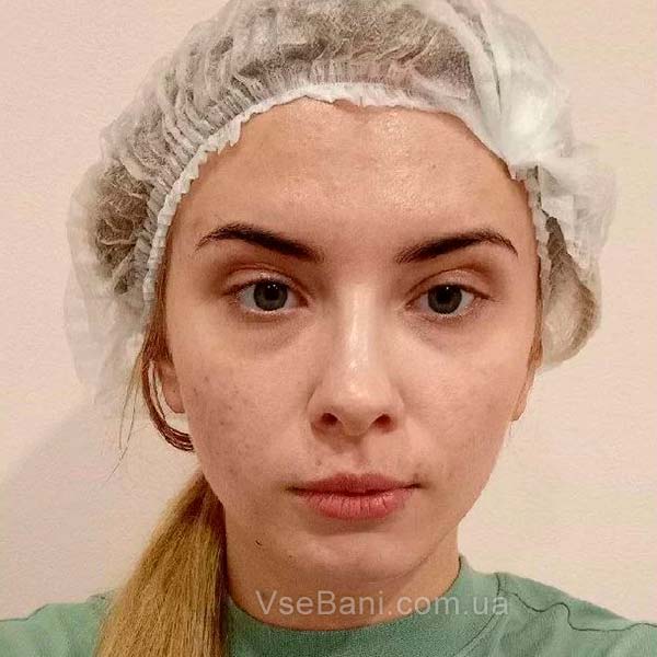 Как избавиться от мелких прыщей на лице