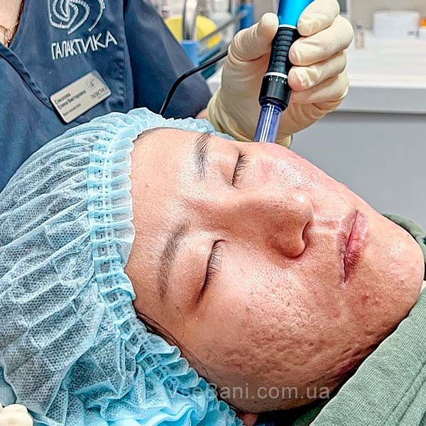 Как убрать шрамы от прыщей на лице 