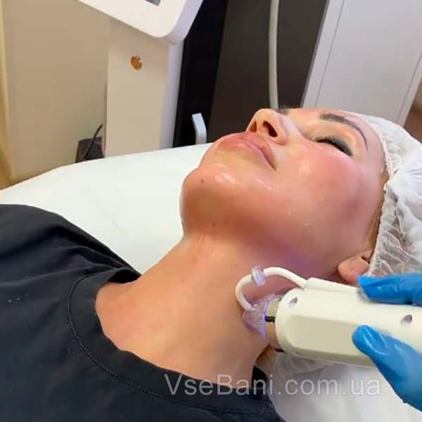 Как убрать следы от прыщей на лице. Лазерная шлифовка