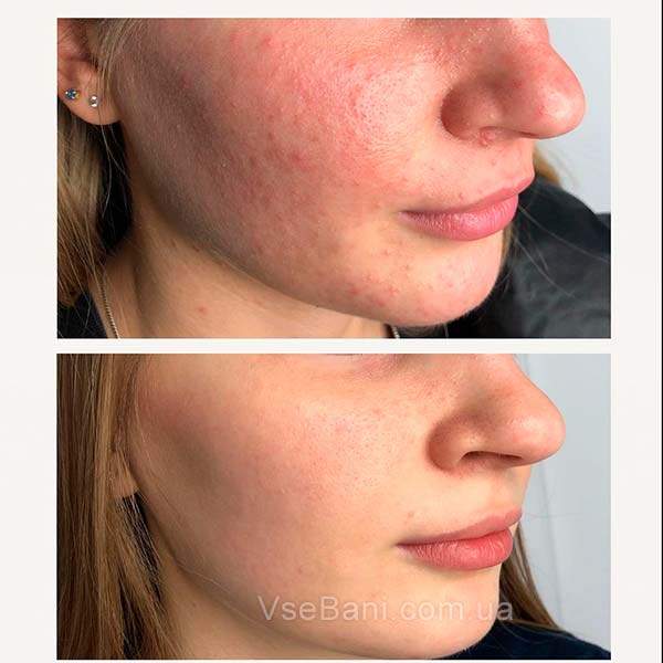 Как убрать прыщи на лице у подростка 