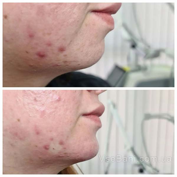 Как избавиться от прыщей на щеках