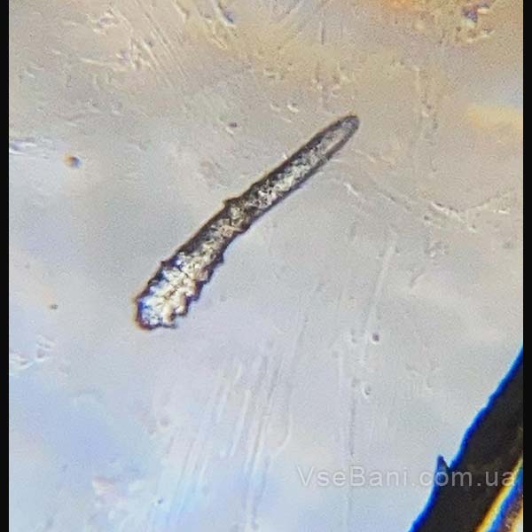 Как избавиться от прыщей на щеках