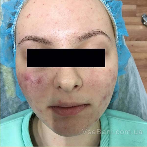 Как избавиться от прыщей на щеках