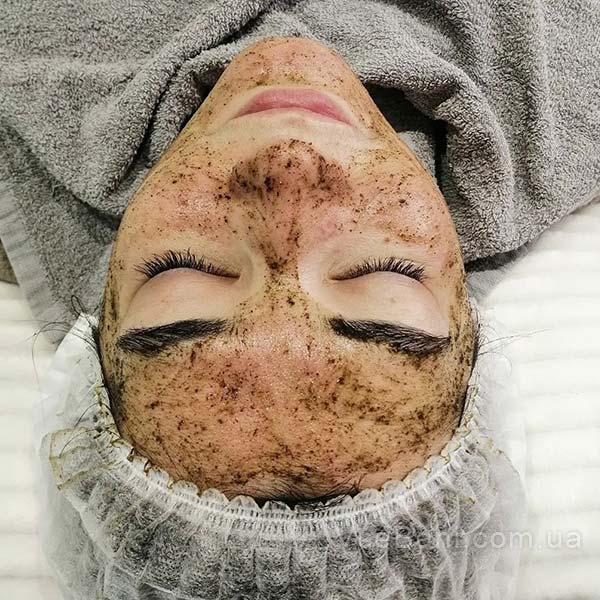 Как избавиться от прыщей на щеках