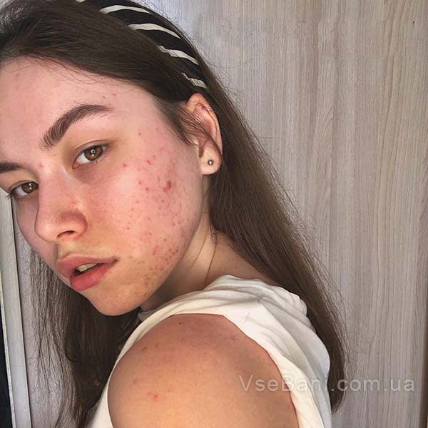 Как избавиться от прыщей в домашних условиях