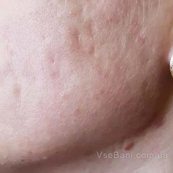 Как избавиться от прыщей в домашних условиях