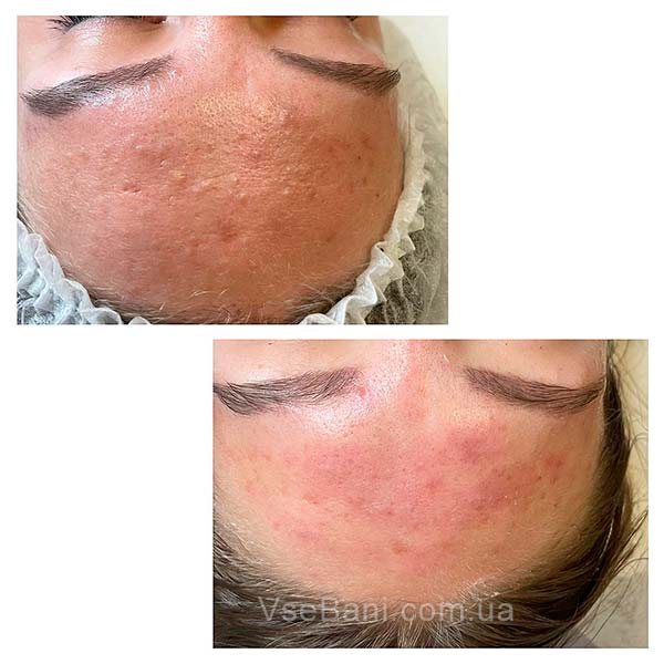 Расширенные поры на лбу