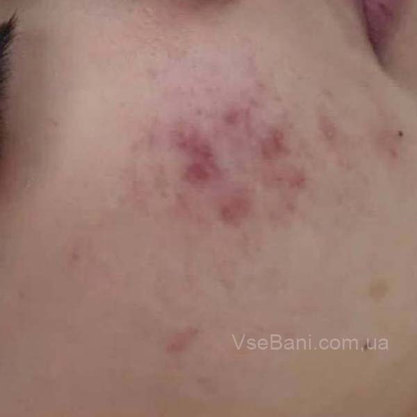 Сыпь на щеках из за вредных привычек