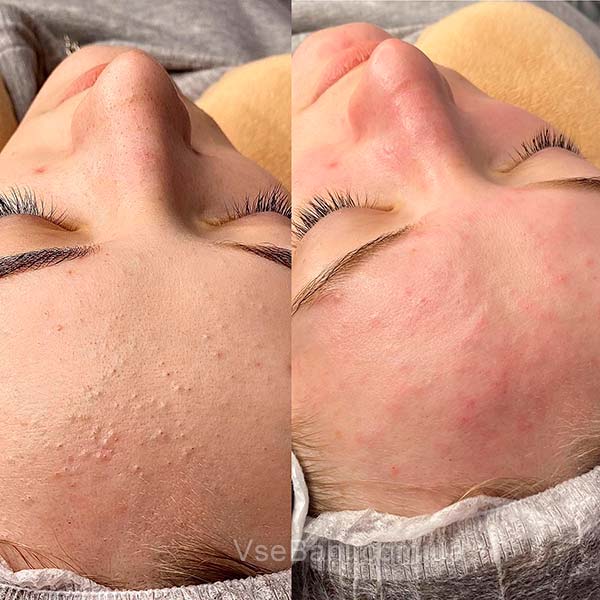 Как убрать Угри на лбу и висках