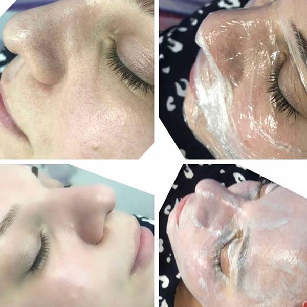 Как избавиться от угрей на носу с помощью кислотного пилинга Как избавиться от угрей на носу с помощью кислотного пилинга