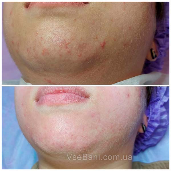 Как избавиться от угрей на подбородке