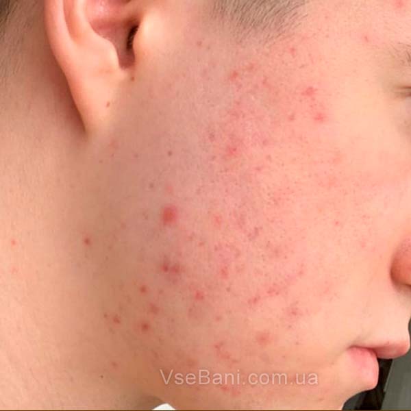 Как избавиться от вульгарных угрей. Гормоны