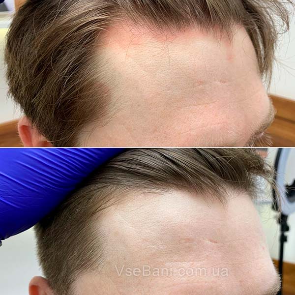 Как избавиться от вульгарных угрей. Себорейный дерматит