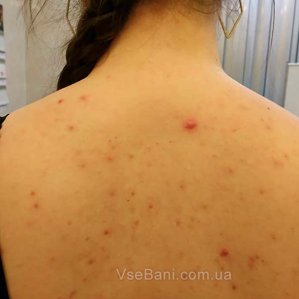 Вульгарные угри на спине