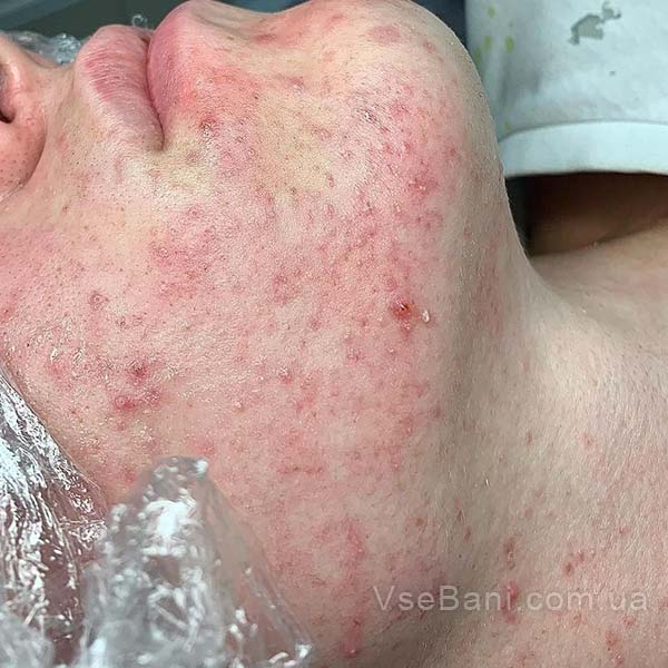 Как снять воспаление с прыща? Как снять воспаление с прыща?