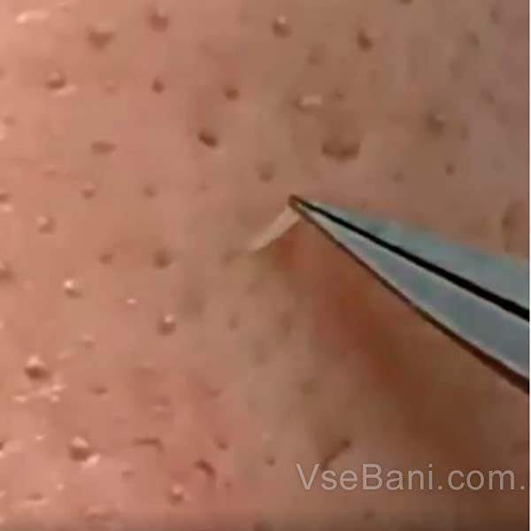 Как убрать черные точки на носу у подростка Как убрать черные точки на носу у подростка