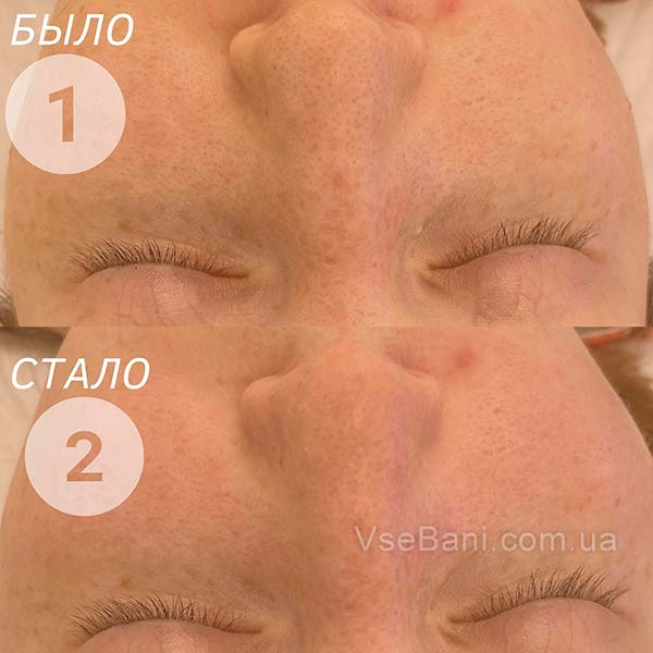 Как убрать черные точки на носу у подростка Как убрать черные точки на носу у подростка